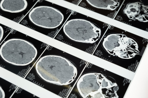 A brain scan image showing neurotransmitter activity decreasing